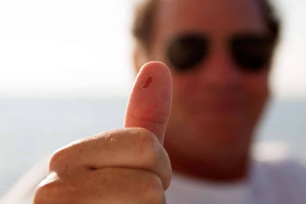a backlash can cause a painful blister on the thumb