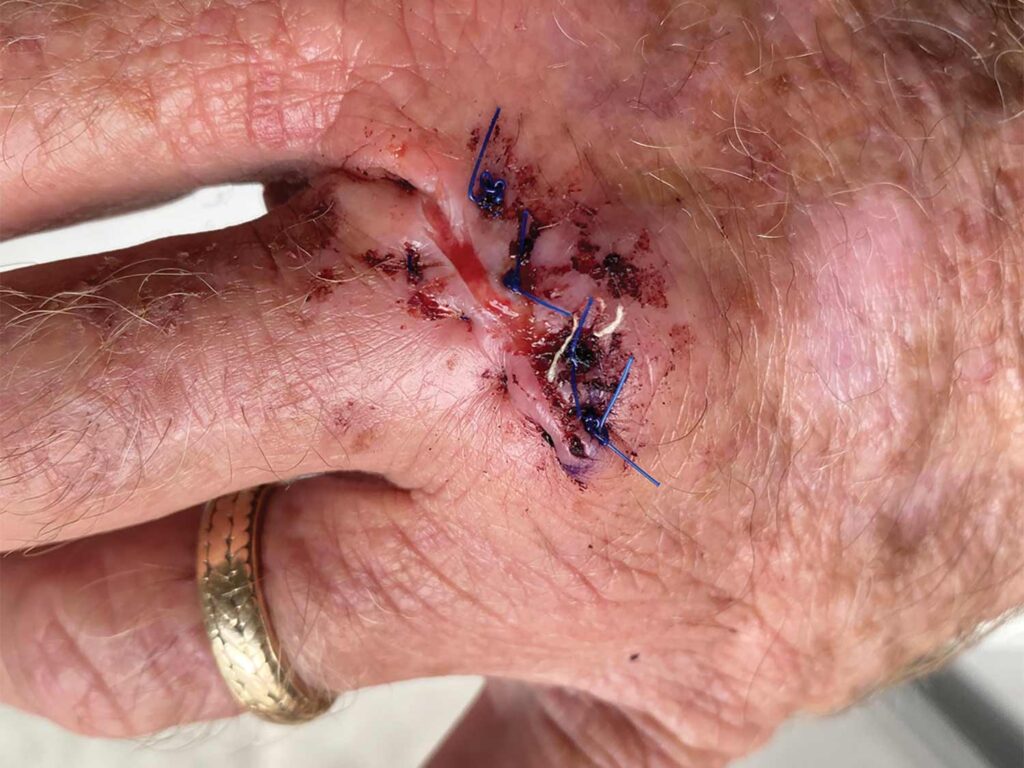 A hand recovering from surgical removal of skin cancers.